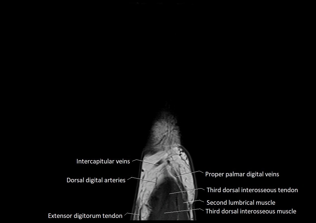 Finger anatomy sagittall cross section 3T image 11.webp